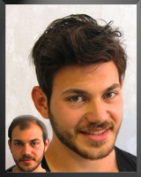 Protez Saç